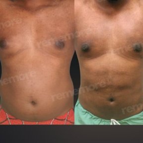 before-after photo liposakcia-zivota
