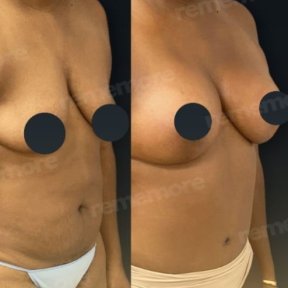 نتائج قبل وبعد عملية تجميل الأم في مستشفى ميموريال غوزتيبي، تحسين شكل الجسم