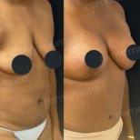 نتائج قبل وبعد عملية تجميل الأم في مستشفى ميموريال غوزتيبي، تحسين شكل الجسم