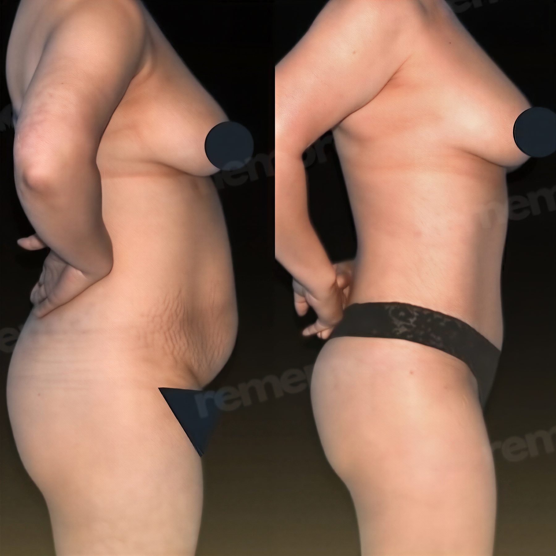 Resultados de mommy makeover antes y después en Memorial Göztepe Hospital, mejora corporal