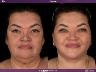 before-after photo brow-lift