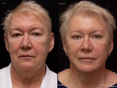 before-after photo brow-lift