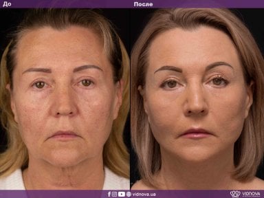 before-after photo brow-lift