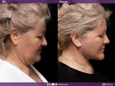 before-after photo tightening-of-facial-skin-facelift