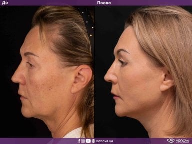 before-after photo tightening-of-facial-skin-facelift