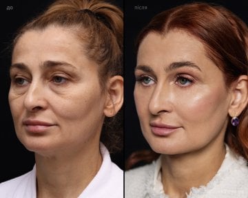 before-after photo tightening-of-facial-skin-facelift