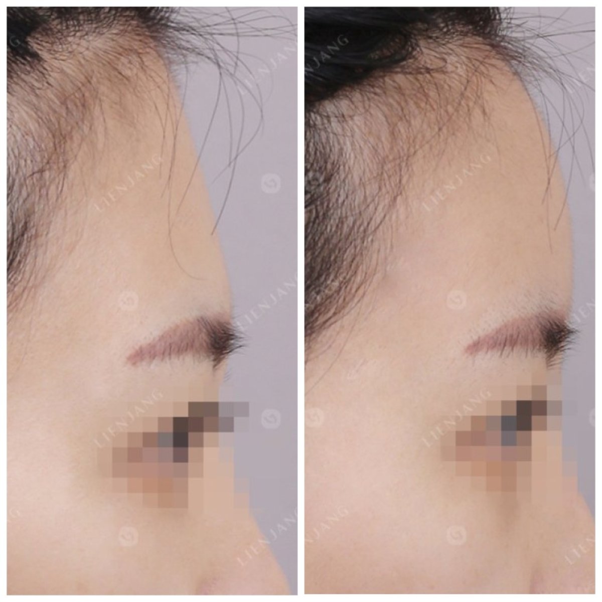 Resultados de transferencia de grasa facial en Lienjang Clinic: frente más llena
