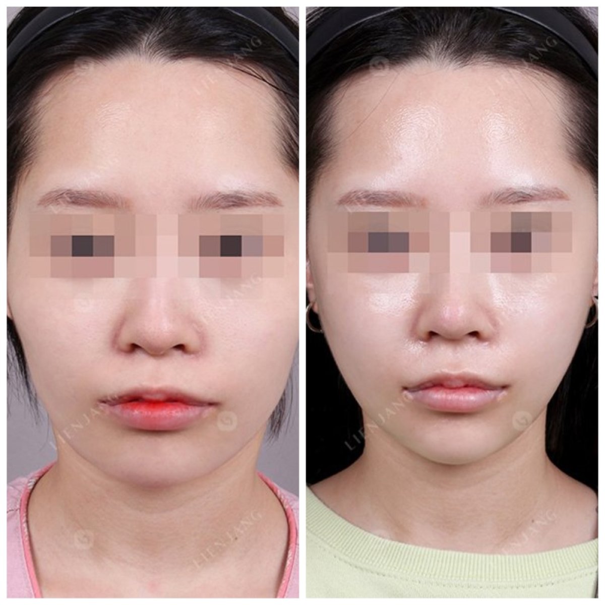 Resultados antes y después de reducción de pómulos, mejora del contorno facial en clínica