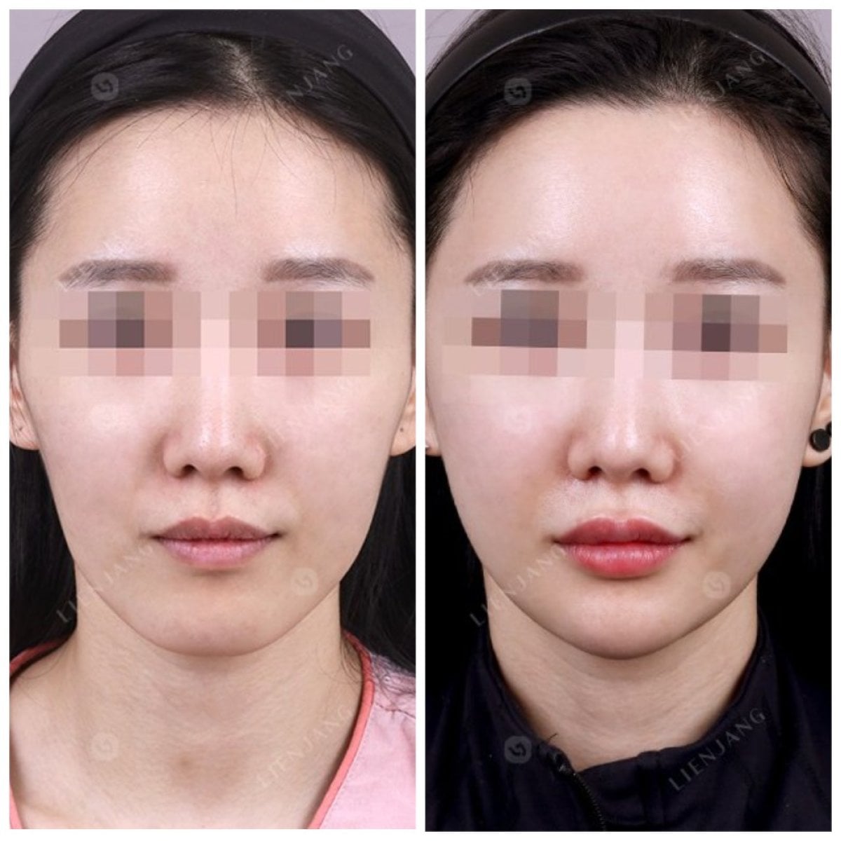 نتائج قبل وبعد تشكيل الفك في عيادة Lienjang – تحسين تحديد ملامح الوجه