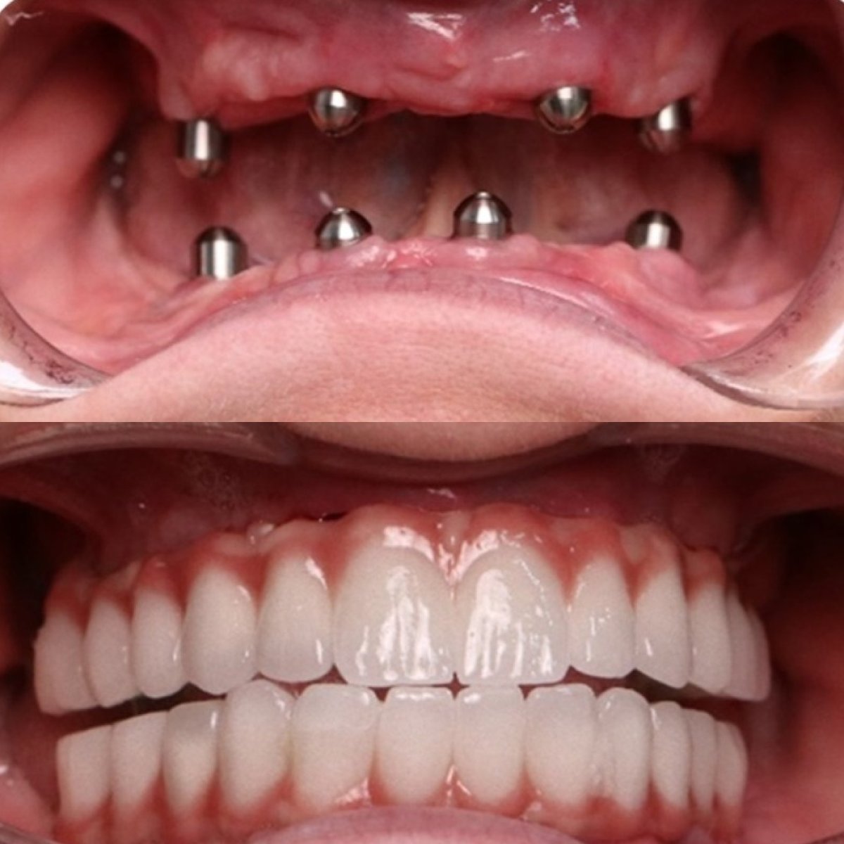 Resultado antes y después de prótesis completa de zirconia sobre 6 implantes de titanio