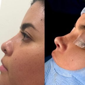 before-after photo rhinoplasty-nose-job