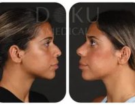 نتائج عملية تجميل الأنف قبل وبعد في Doku Medical، إعادة تشكيل الأنف بمظهر طبيعي