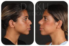 نتائج عملية تجميل الأنف قبل وبعد في Doku Medical، إعادة تشكيل الأنف بمظهر طبيعي