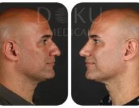 نتائج عملية تجميل الأنف قبل وبعد في Doku Medical، تحسين شكل الأنف لرجل