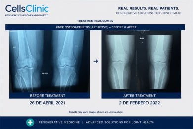 before-after photo osteoarthritis-stem-cell-treatment