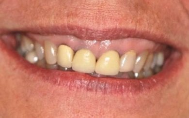 before-after photo installation-of-a-veneer