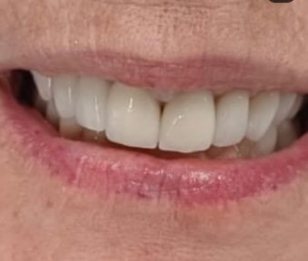before-after photo installation-of-a-veneer