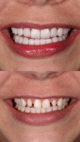 before-after photo installation-of-a-veneer