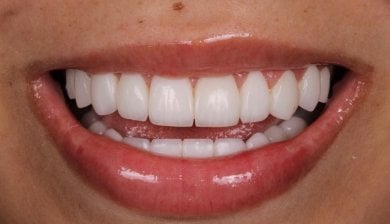 before-after photo installation-of-a-veneer