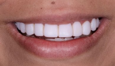 before-after photo installation-of-a-veneer