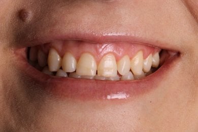 before-after photo installation-of-a-veneer
