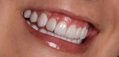 before-after photo installation-of-a-veneer