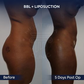 before-after photo mommy-makeover