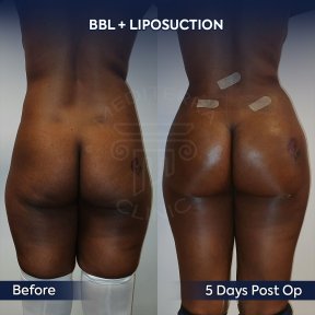 before-after photo mommy-makeover