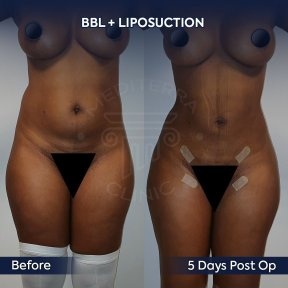 before-after photo mommy-makeover