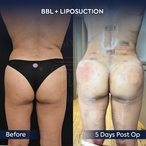 before-after photo mommy-makeover
