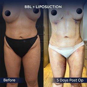 before-after photo mommy-makeover