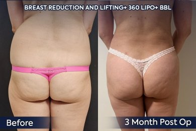 before-after photo mommy-makeover