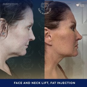 Vorher-nachher-Ergebnis Facelift und Halslift mit Fettinjektion bei Dr. Safa Manav Clinic