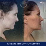 Vorher-nachher-Ergebnis Facelift und Halslift mit Fettinjektion bei Dr. Safa Manav Clinic