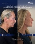 Vorher-nachher-Ergebnis Facelift und Halslift bei Dr. Safa Manav Clinic, sichtbare Verjüngung