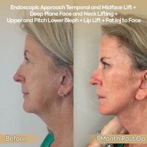 Vorher-nachher-Ergebnis Deep Plane Facelift bei Dr. Safa Manav Clinic, sichtbare Verjüngung