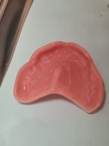 before-after photo full-dentures-installation
