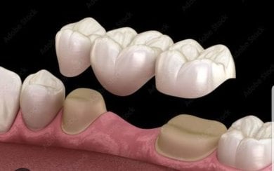 before-after photo zirconia-dental-bridge