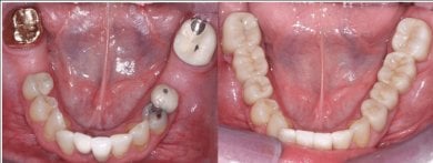 before-after photo zirconia-dental-bridge