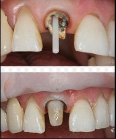 Before and after dental crown installation at SoftDentalCare Clinic, visible tooth restoration result