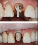 Before and after dental crown installation at SoftDentalCare Clinic, visible tooth restoration result