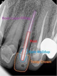 Dental crown installation X-ray result at SoftDentalCare Clinic showing post and core buildup