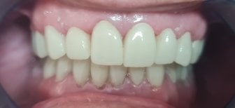 Dental crown installation result at SoftDentalCare Clinic – restored and natural-looking teeth