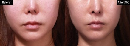 Before and after lip lift results at VG Plastic Surgery, enhanced lip contour and symmetry