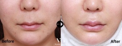 Before and after lip lift results at VG Plastic Surgery, enhanced upper lip contour and volume
