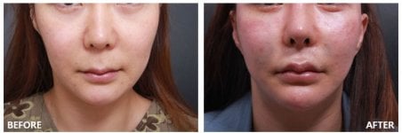 Before and after lip lift results at VG Plastic Surgery, enhanced upper lip contour visible