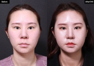 Before and after lip lift results at VG Plastic Surgery, enhanced lip contour and fuller shape