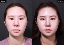 Before and after lip lift results at VG Plastic Surgery, enhanced lip contour and fuller shape