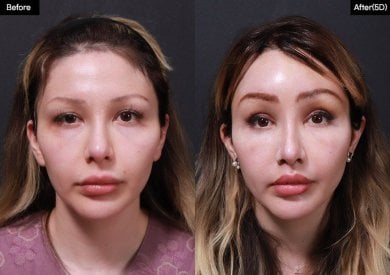 Before and after lip lift results at VG Plastic Surgery, enhanced lip contour and volume