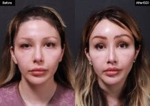 Before and after lip lift results at VG Plastic Surgery, enhanced lip contour and volume